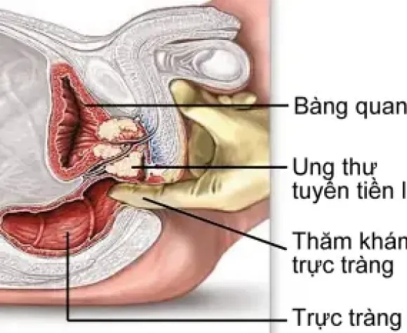 Ung thư tiền liệt tuyến