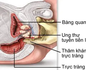 Ung thư tiền liệt tuyến